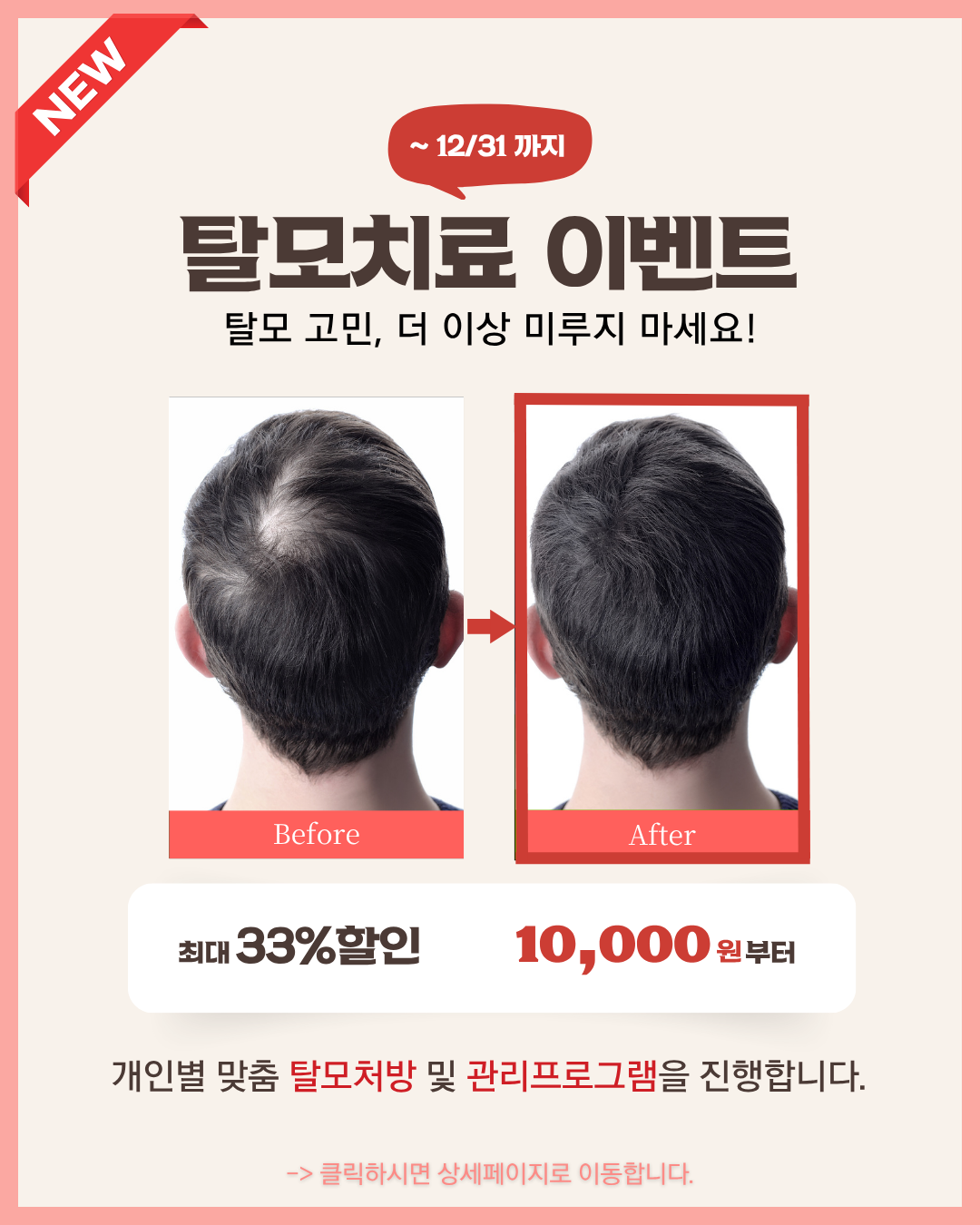 은삼성의원 성형외과 탈모치료 BIG EVENT!